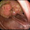 Imágenes endoscópicas » Colon » Cáncer de colon