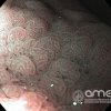 Imágenes endoscópicas &raquo; Duodeno &raquo; Metaplasia gástrica