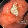 Imágenes endoscópicas » Estómago » Úlcera gástrica