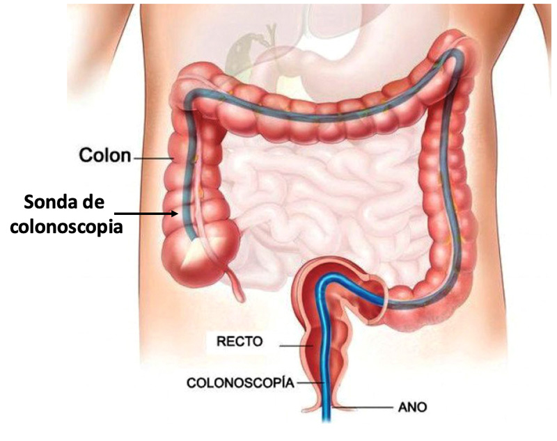 colonoscopia 01