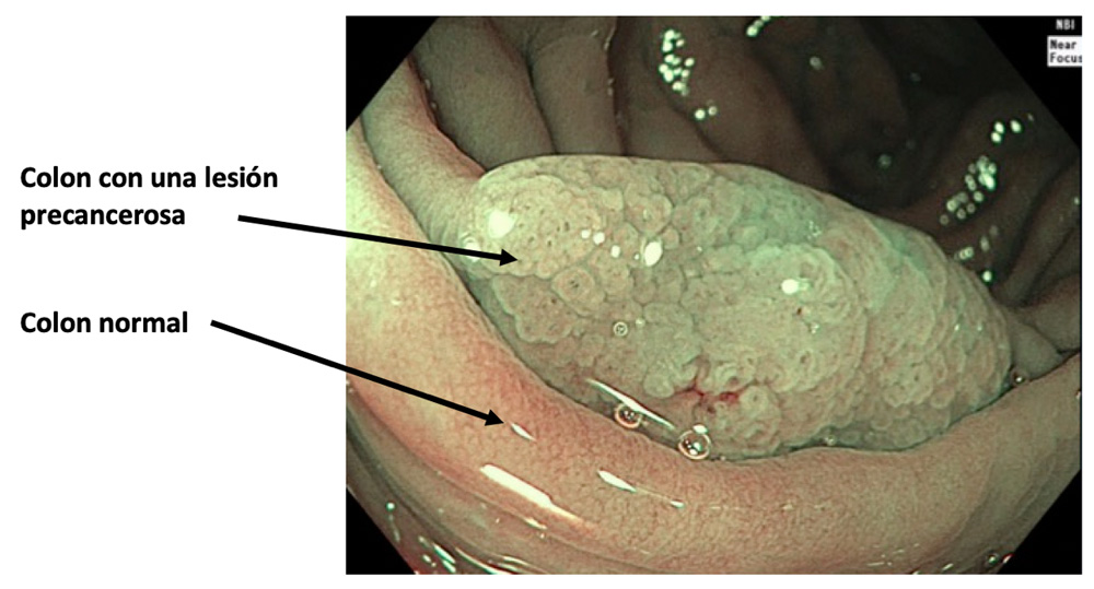 colonoscopia 02