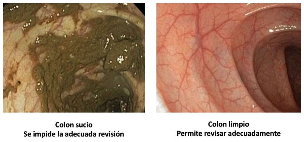 colonoscopia 03