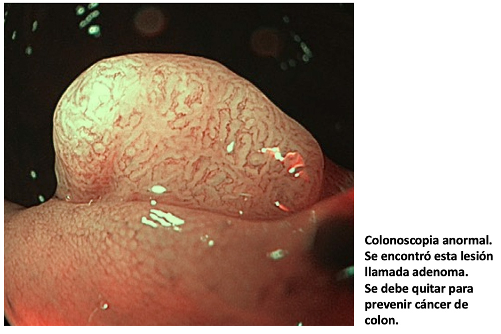 colonoscopia 04