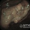 Imágenes endoscópicas » Colon » Adenoma con patron no granular