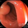 Imágenes endoscópicas » Colon » Lipoma