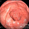 Imágenes endoscópicas » Colon » Proctitis