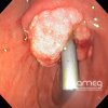 Imágenes endoscópicas » Duodeno » Adenoma