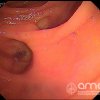 Imágenes endoscópicas » Duodeno » Diverticulos