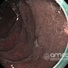 Imágenes endoscópicas » Duodeno » Erosión duodenal