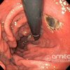 Imágenes endoscópicas » Estómago » Úlcera gástrica isquemica